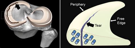 meniscus polarimeter|diagnosis for meniscus tear.